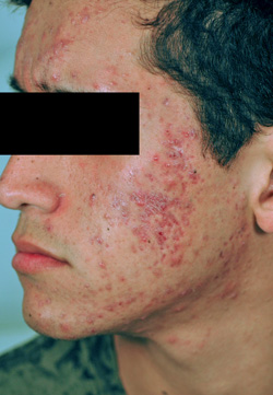Los Angeles laser acne and acne scars treatment Before and After Pictures