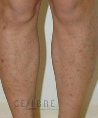 Before and After Scar Removal for Bug Bites on Legs - 2