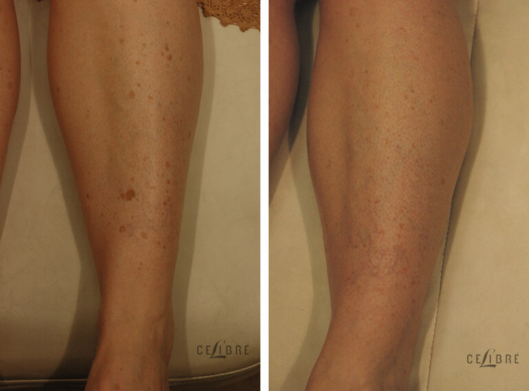 sun-spots-removal-before-and-after-pictures-9