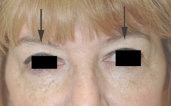 Botox Brow Lift After Pictures