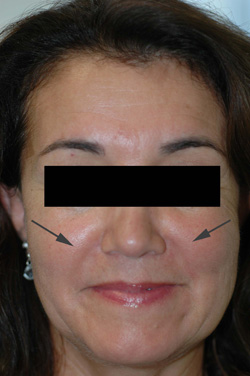 Los Angeles Restylane Injections before and After Pictures