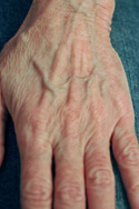 laser hand rejuvenation before and After Pictures