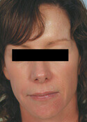 Los Angeles Facial Rejuvenation before and After Pictures