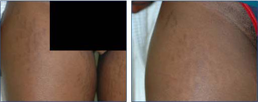 stretch marks removal