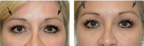 Brow Lift Botox Injection Torrance CA