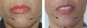 botox injections for pebble chin Orange CA