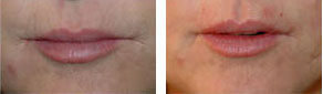 Botox Lip Wrinkles Torrance CA