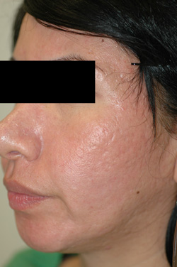 Orange County Acne Scar Removal Before and After Pictures