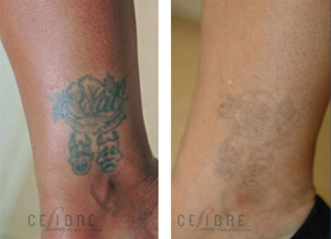 What will My Laser Tattoo Removal Cost?