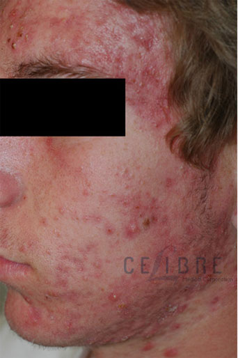 Acne Treatment Before and After Pictures 3