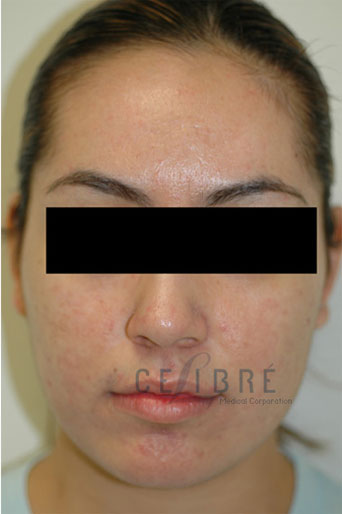 Acne Treatment Before and After Pictures 4