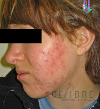 Acne Treatment Before Pictures 5