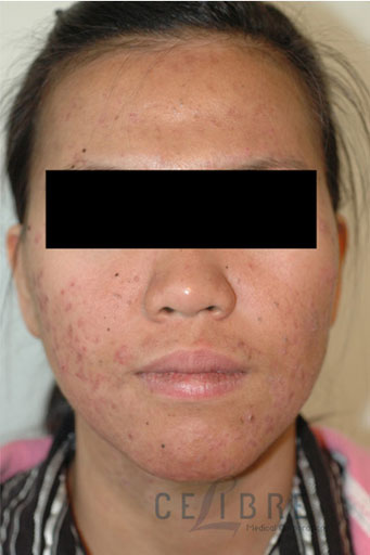 Acne Treatment Before and After Pictures 7