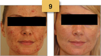 Acne Treatment Before and After Pictures Sm 9
