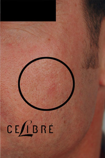 Acne Scar Removal After Pictures 3