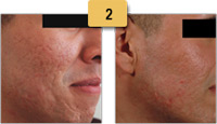 Acne Scar Removal Before and After Pictures Sm 2