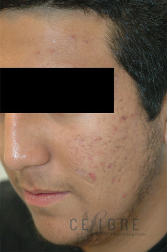 Acne Scar Removal After Pictures 6