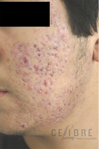 Acne Scar Removal Before Pictures 6