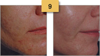 Acne Scar Laser Treatment Before and After Pictures Sm 9