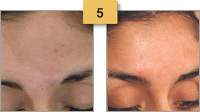 Birthmark Removal Before and After Pictures Sm 5