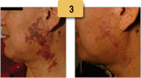 Vascular Birthmark Removal Before and After Pictures Sm 3