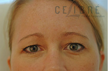 Brow Lift Botox Before Pictures 1 by Celibre Medical Corporation