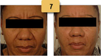 Frown Lines Botox Before and After Pictures Sm 7