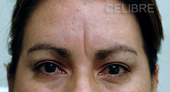 deep frown lines before Botox and Juvederm