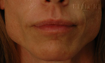 Masseter Before Dysport Injections Picture 11