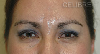 Glabella After Dysport Injections Picture 12