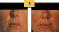 Juvederm Before and After Smile Lines Pictures Sm 6
