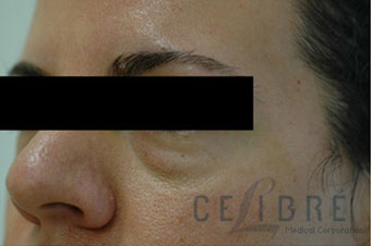 Juvederm Injections Before Pictures 7