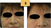 Juvederm Tired Eyes Before and After Pictures Sm 8