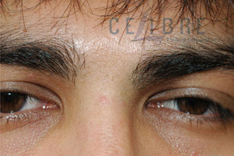 Unibrow Laser Hair Removal After Picture 4 by Celibre Medical Corporation