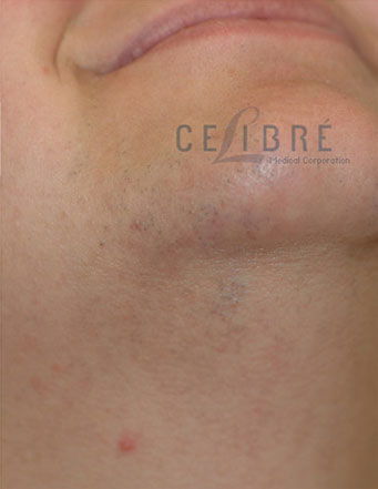 Facial Hairs Laser Hair Removal After Picture 5 by Celibre Medical Corporation