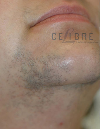 Facial Hairs Laser Hair Removal Before Picture 5 by Celibre Medical Corporation