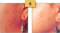 Laser Hair Removal Before and After Pictures Sm 6