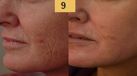 Laser Resurfacing Before and After Pictures Sm 1