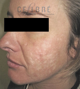 Laser Resurfacing Before Pictures 5