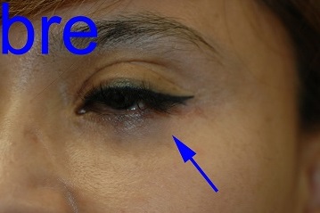Laser Resurfacing After Pictures 7