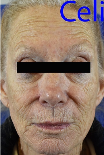 Laser Resurfacing Before Pictures 7