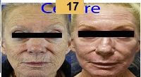 Profractional Laser Resurfacing Before and After Pictures Sm 1