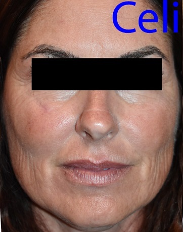 Laser Resurfacing Before Pictures 7