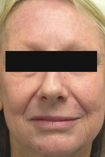 Laser Resurfacing After Pictures 7