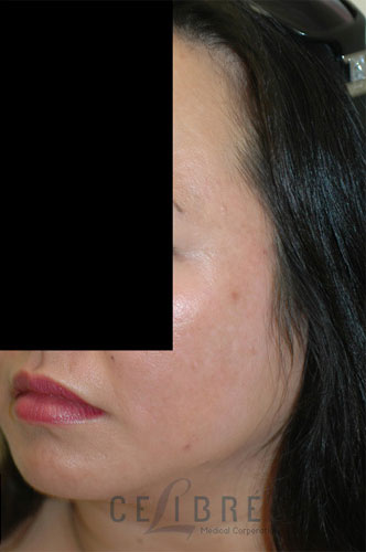 Melasma After Pictures 1