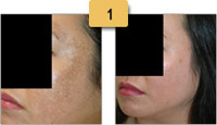 Melasma Before and After Pictures Sm 1