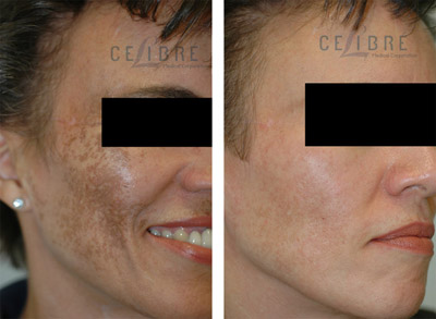 melasma before and after picture