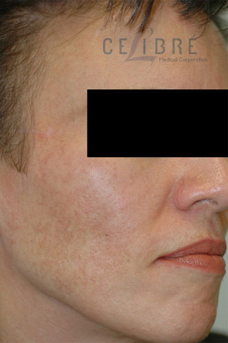 Before and After Melasma on Cheeks - 2