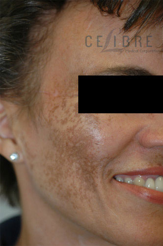 Melasma Before Pictures 2