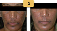 Melasma Before and After Pictures Sm 3